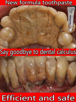 zubnému kameňu odstraňovač bielenie zubov v ústach vôňa, odstránenie zlého dychu Prevencia Periodontitis zubná pasta fluoridu